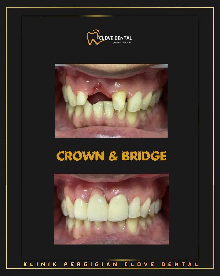 Before and after: crown and bridge at Clove Dental