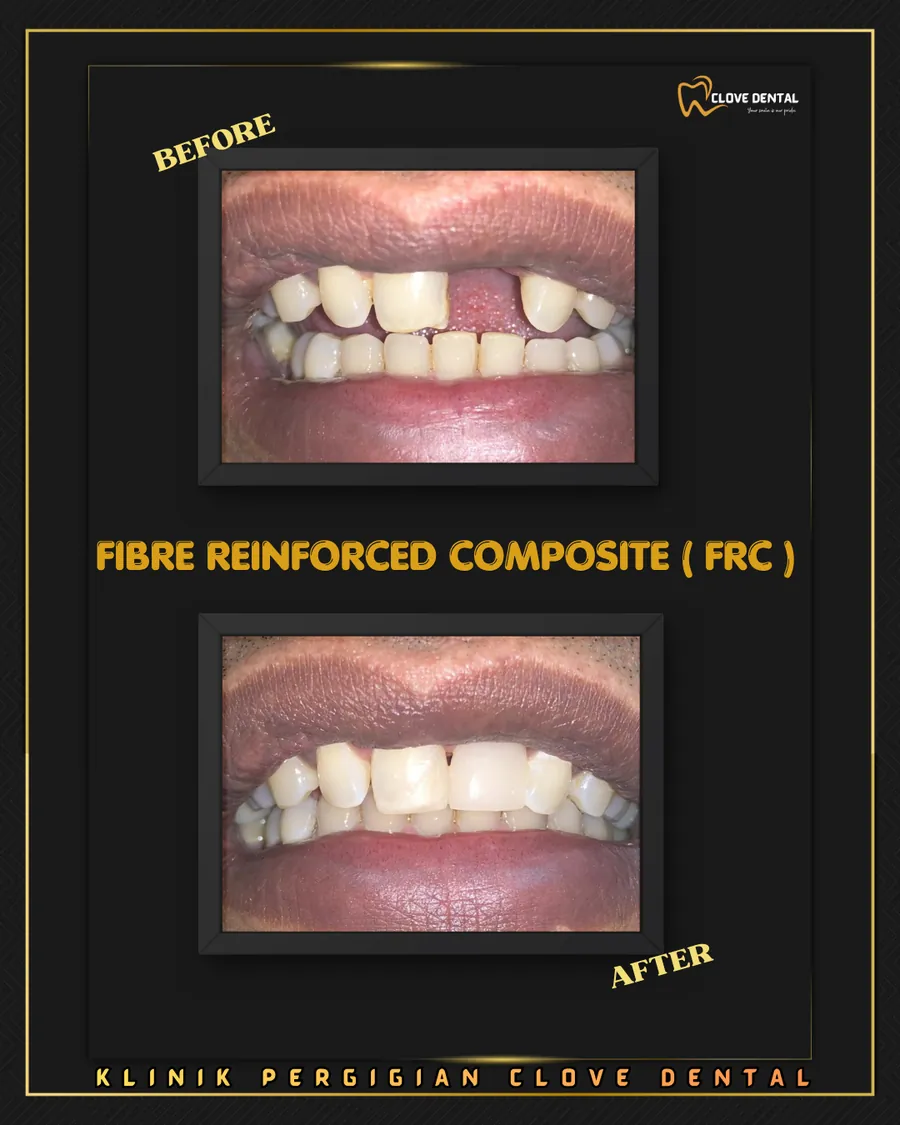 Before and after: fibre-reinforced composite at Clove Dental