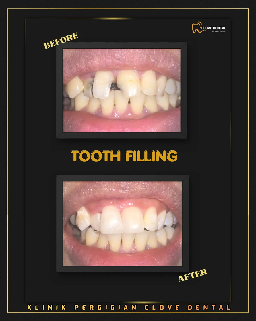 Before and after: front tooth filling at Clove Dental