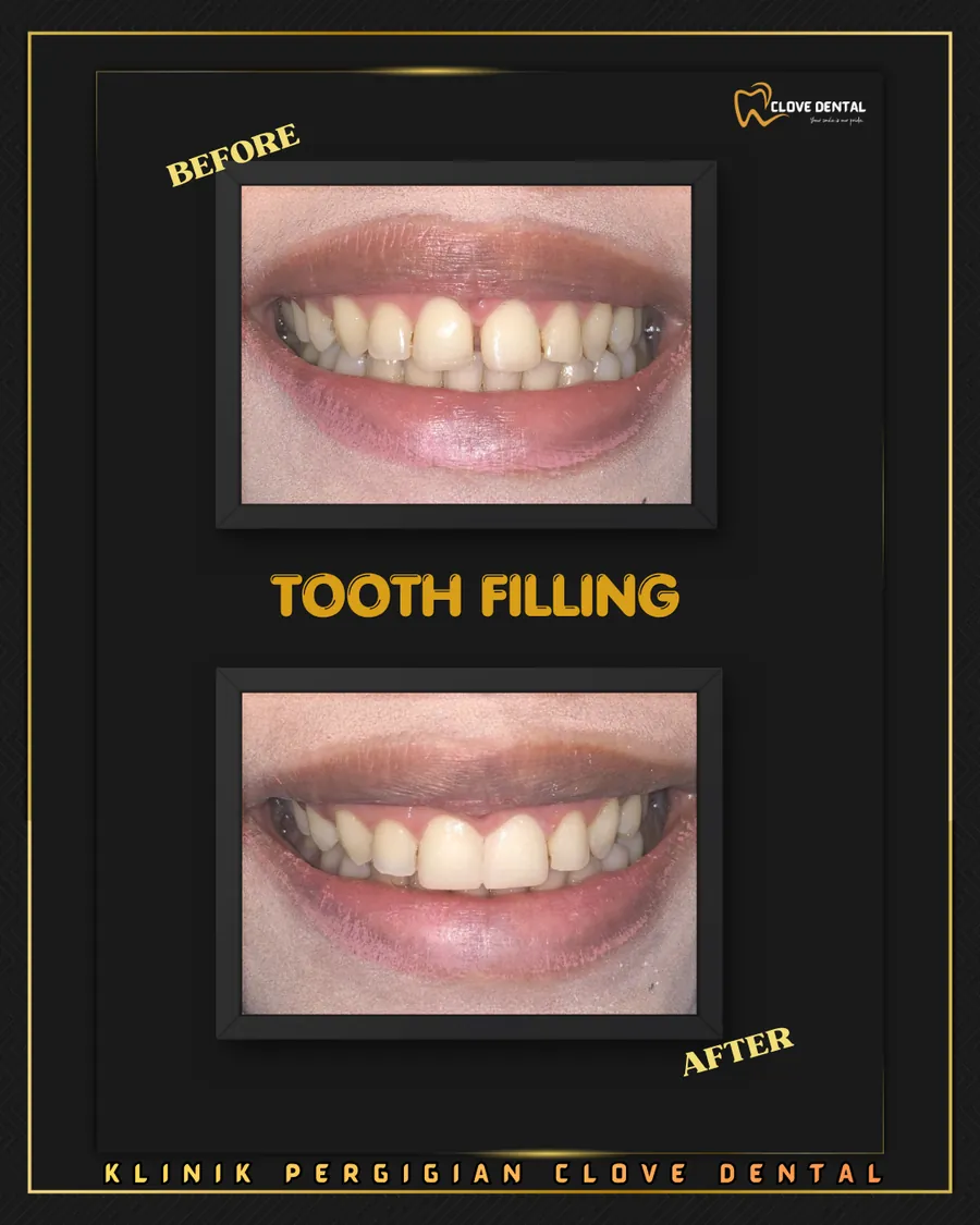 Before and after: closing a front gap at Clove Dental