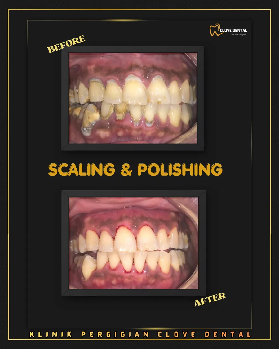 Before and after: scaling and polishing at Clove Dental